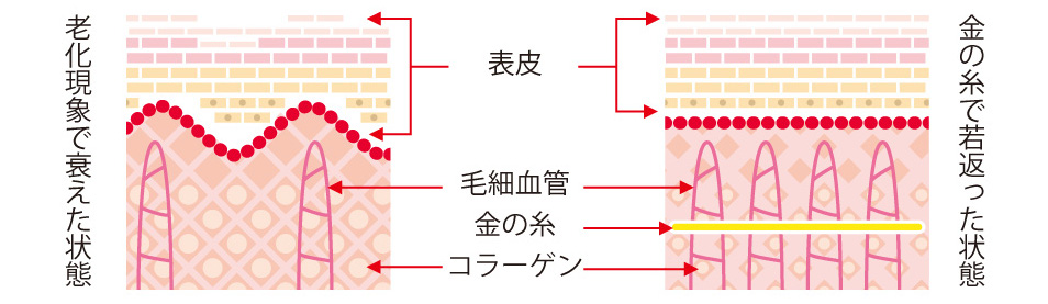 金の糸治療概要