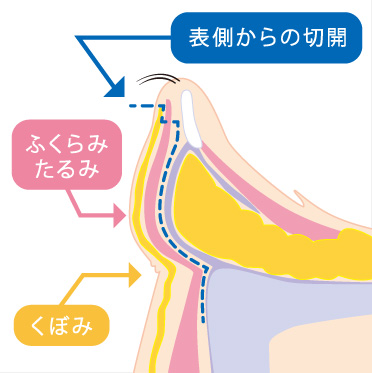 ハムラ法概要_イラスト01