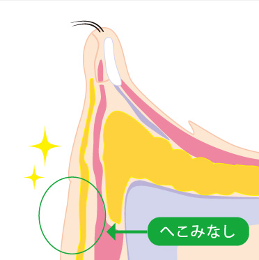 ハムラ法概要_イラスト04